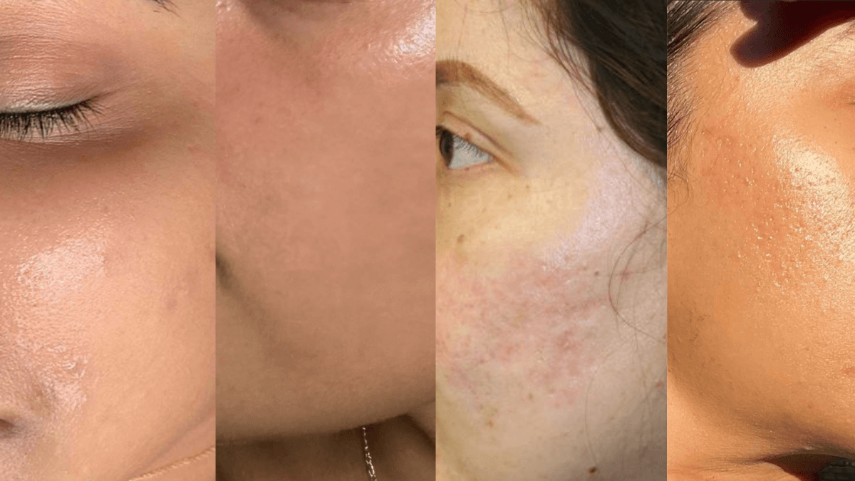 Acne Scars after