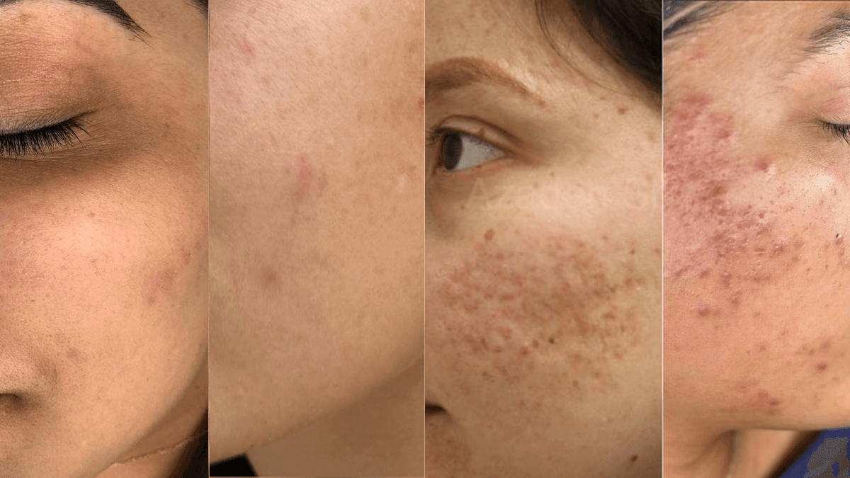 Acne Scars before