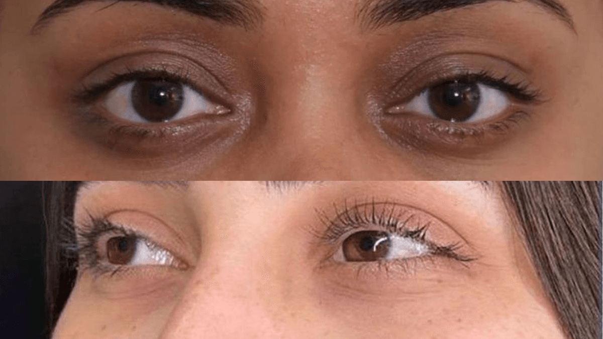 Dark Circles after