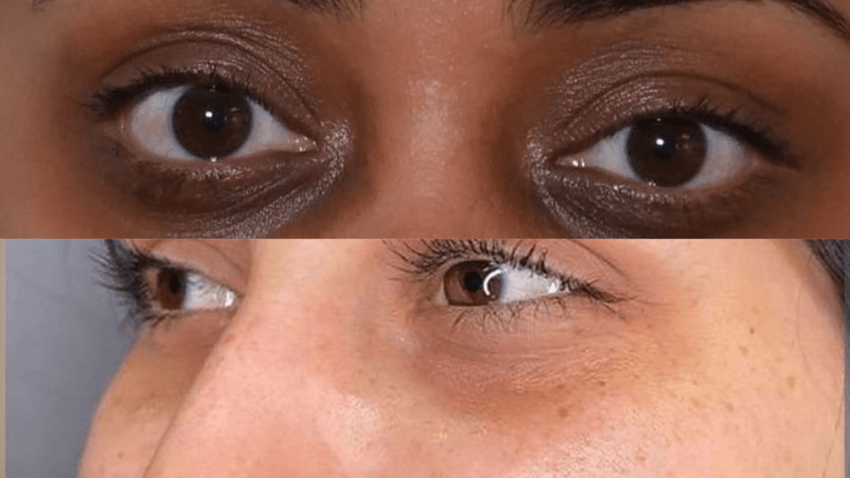 Dark Circles before
