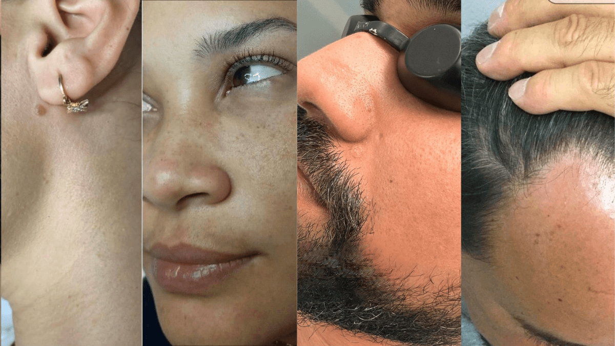 Mole Removal after