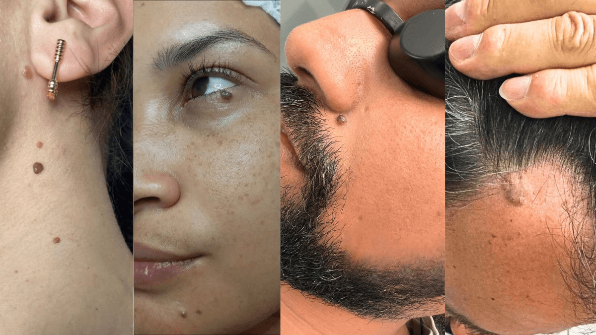 Mole Removal before
