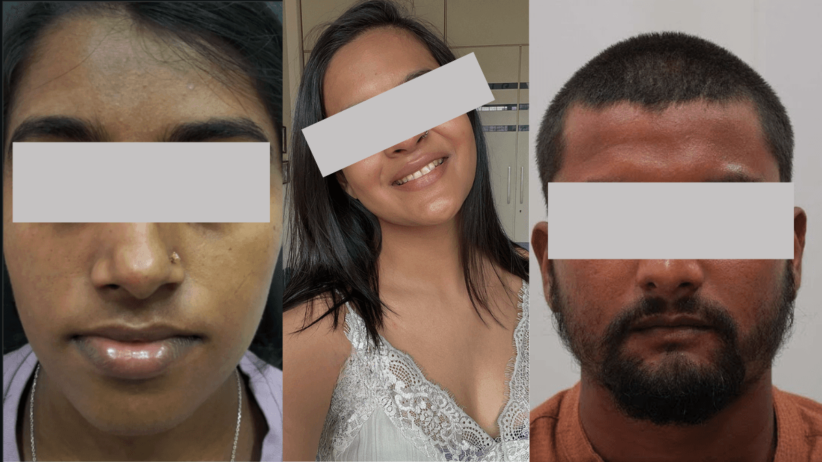 Skin Lightening & Tan Removal before